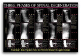 Three Phases of Spinal Degeneration
